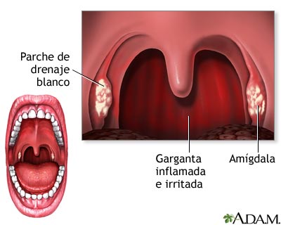 anginas 13